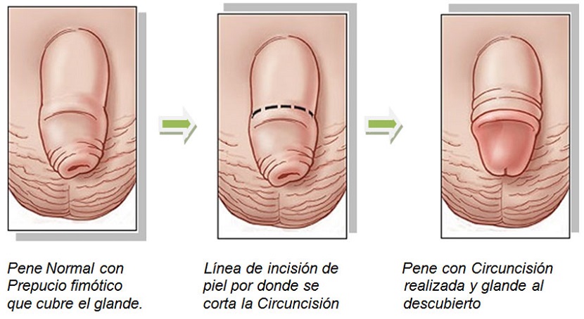 Los beneficios de la circuncisión