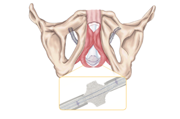 Sistema de sling masculino AdVanceTM para incontinencia urinaria