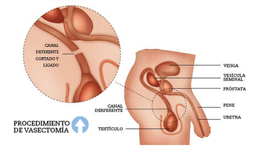 Vasectomía- qué puedo esperar